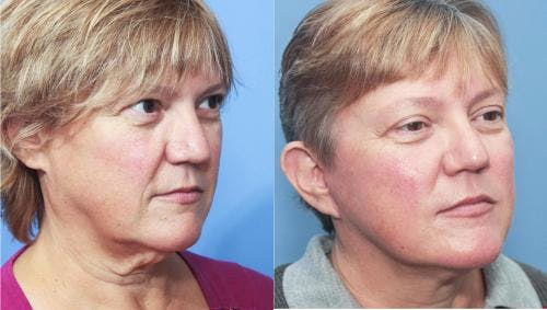 Face Lift Before & After Gallery - Patient 58213204 - Image 1