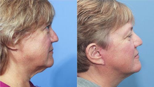 Face Lift Before & After Gallery - Patient 58213204 - Image 3