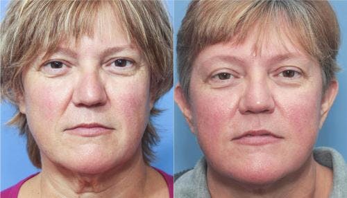 Face Lift Before & After Gallery - Patient 58213204 - Image 1