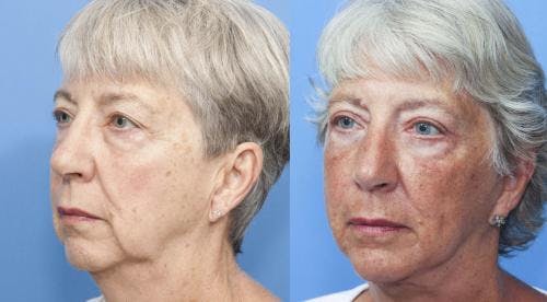 Face Lift Before & After Gallery - Patient 58213207 - Image 2