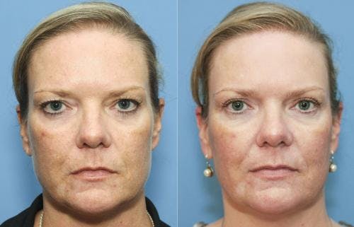 Eyelid Surgery (Upper Blepharoplasty) Before & After Gallery - Patient 58213206 - Image 1