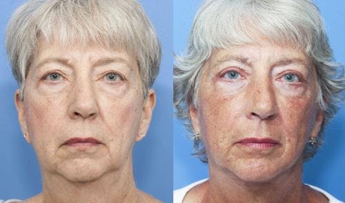 Face Lift Before & After Gallery - Patient 58213207 - Image 1