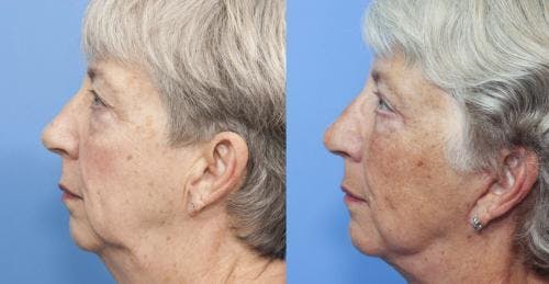 Face Lift Before & After Gallery - Patient 58213207 - Image 3