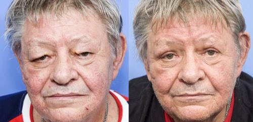Eyelid Surgery (Blepharoplasty) Before & After Gallery - Patient 58213209 - Image 1