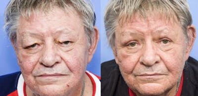 Eyelid Surgery (Upper Blepharoplasty) Before & After Gallery - Patient 58213209 - Image 1