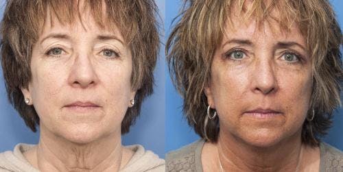 Face Lift Before & After Gallery - Patient 58213211 - Image 1
