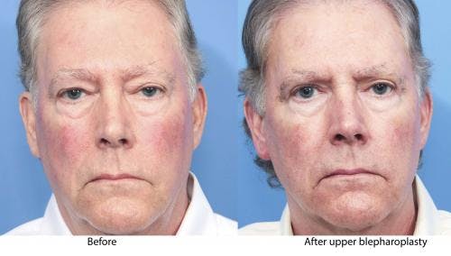 Eyelid Surgery (Blepharoplasty) Before & After Gallery - Patient 58213210 - Image 1