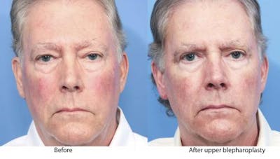 Eyelid Surgery (Upper Blepharoplasty) Before & After Gallery - Patient 58213210 - Image 1