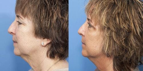 Face Lift Before & After Gallery - Patient 58213211 - Image 2
