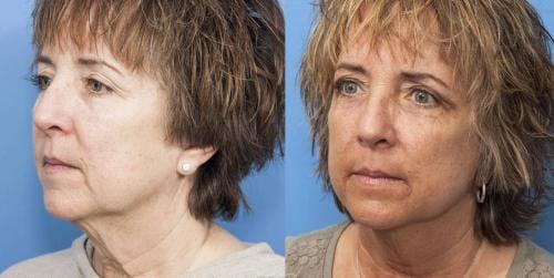 Face Lift Before & After Gallery - Patient 58213211 - Image 3