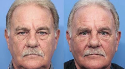 Eyelid Surgery (Upper & Lower Blepharoplasty) Before & After Gallery - Patient 269473 - Image 1