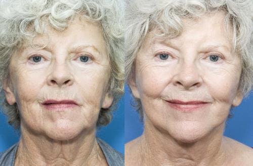 Face Lift Before & After Gallery - Patient 58213214 - Image 1