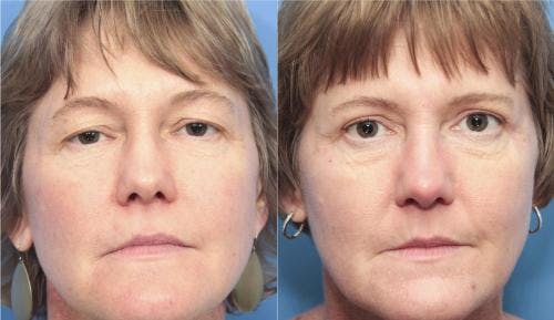 Eyelid Surgery (Upper Blepharoplasty) Before & After Gallery - Patient 58213213 - Image 1