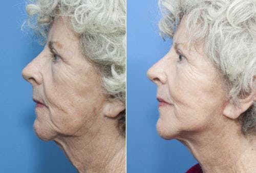Face Lift Before & After Gallery - Patient 58213214 - Image 2