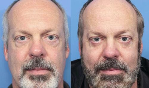 Eyelid Surgery (Blepharoplasty) Before & After Gallery - Patient 58213215 - Image 1