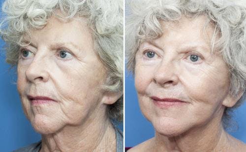 Face Lift Before & After Gallery - Patient 58213214 - Image 3