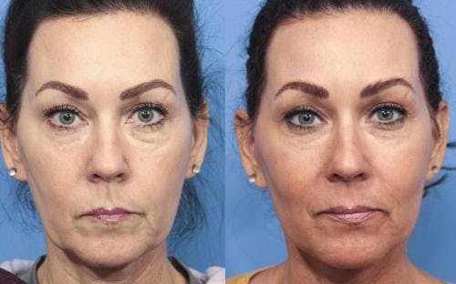 Face Lift Before & After Gallery - Patient 58213219 - Image 1