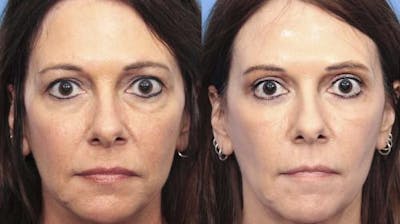 Eyelid Surgery (Upper & Lower Blepharoplasty) Before & After Gallery - Patient 154374 - Image 1