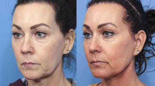 Face Lift Before & After Gallery - Patient 58213219 - Image 2