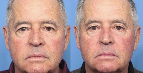 Eyelid Surgery (Blepharoplasty) Before & After Gallery - Patient 58213217 - Image 1