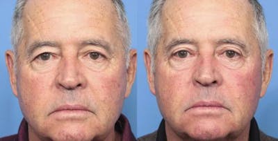 Eyelid Surgery (Upper Blepharoplasty) Before & After Gallery - Patient 58213217 - Image 1