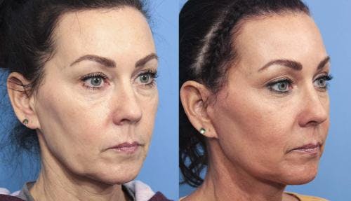 Face Lift Before & After Gallery - Patient 58213219 - Image 3