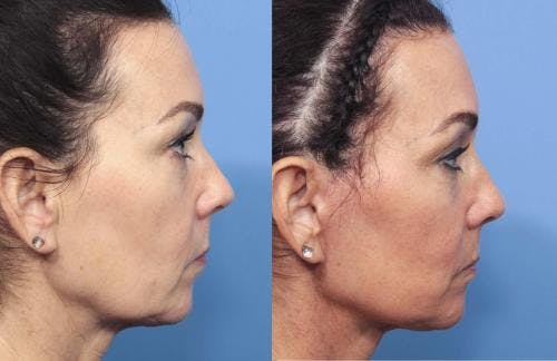 Face Lift Before & After Gallery - Patient 58213219 - Image 4