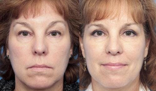 Eyelid Surgery (Upper Blepharoplasty) Before & After Gallery - Patient 58213218 - Image 1