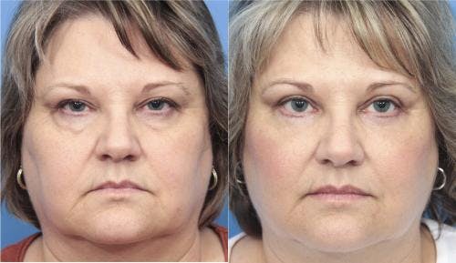 Eyelid Surgery (Upper & Lower Blepharoplasty) Before & After Gallery - Patient 270205 - Image 1