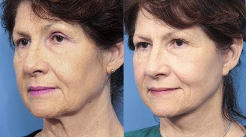 Face Lift Before & After Gallery - Patient 58213223 - Image 1