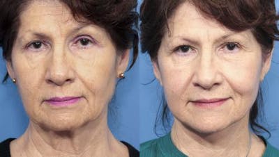Face Lift Before & After Gallery - Patient 58213223 - Image 1