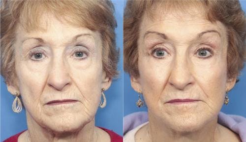 Face Lift Before & After Gallery - Patient 58213224 - Image 1