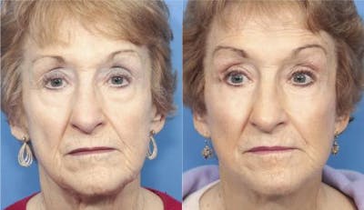 Face Lift Before & After Gallery - Patient 58213224 - Image 1
