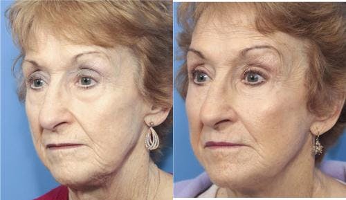 Face Lift Before & After Gallery - Patient 58213224 - Image 2