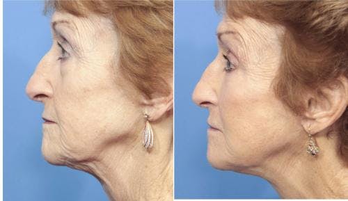 Face Lift Before & After Gallery - Patient 58213224 - Image 3