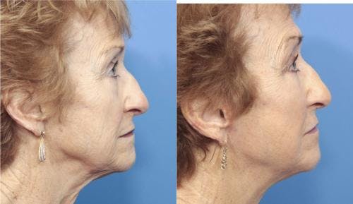 Face Lift Before & After Gallery - Patient 58213224 - Image 4