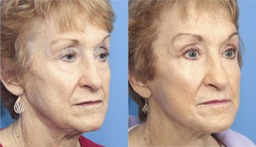 Face Lift Before & After Gallery - Patient 58213224 - Image 5