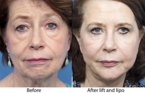 Face Lift Before & After Gallery - Patient 58213233 - Image 1