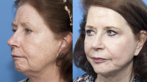 Face Lift Before & After Gallery - Patient 58213233 - Image 2