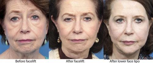 Face Lift Before & After Gallery - Patient 58213233 - Image 5