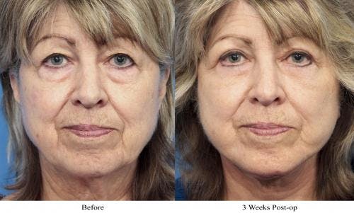 Face Lift Before & After Gallery - Patient 58213234 - Image 1