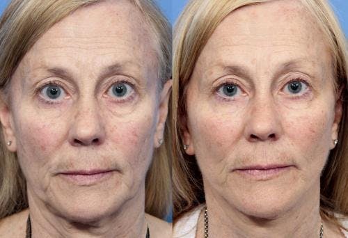 Face Lift Before & After Gallery - Patient 58213236 - Image 1