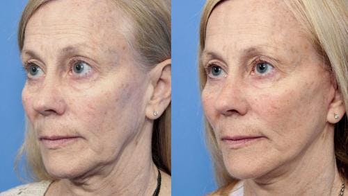 Face Lift Before & After Gallery - Patient 58213236 - Image 2