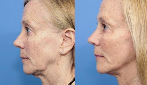 Face Lift Before & After Gallery - Patient 58213236 - Image 3