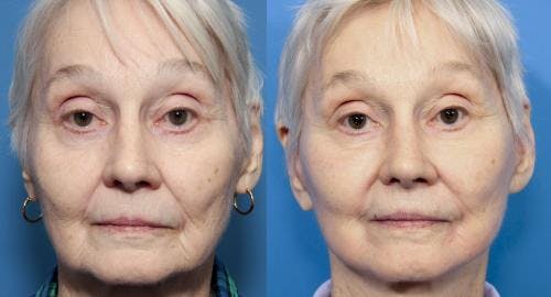 Face Lift Before & After Gallery - Patient 58213237 - Image 1
