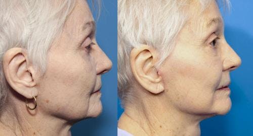 Face Lift Before & After Gallery - Patient 58213237 - Image 2