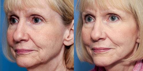 Face Lift Before & After Gallery - Patient 58213238 - Image 1