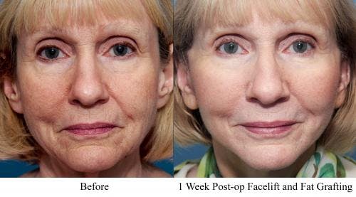 Face Lift Before & After Gallery - Patient 58213239 - Image 1