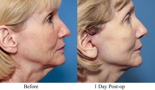 Face Lift Before & After Gallery - Patient 58213239 - Image 2
