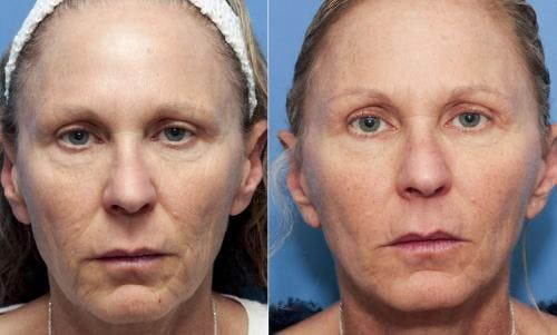 Face Lift Before & After Gallery - Patient 58213240 - Image 1